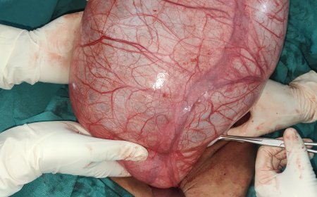 एम टी एच अस्पताल मे 15 वर्षीय बालिका के पेट से निकाली आठ किलो की गठान l