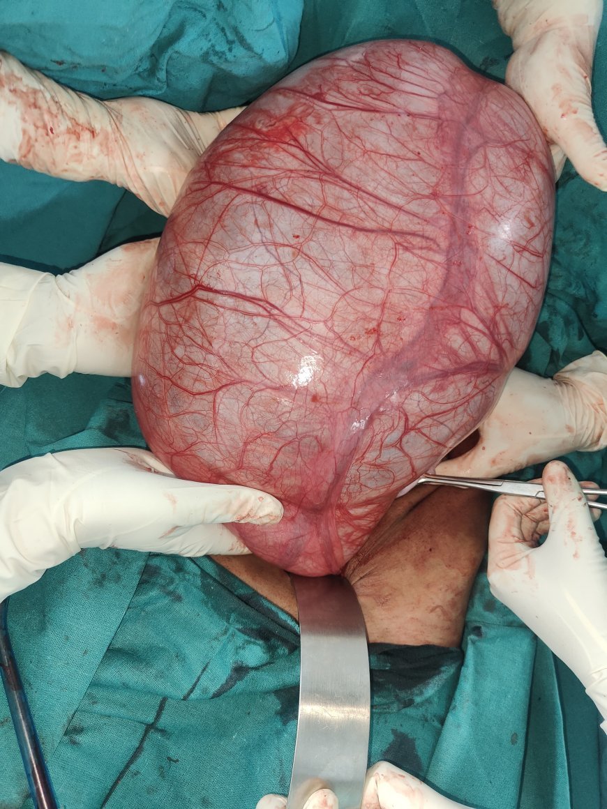 एम टी एच अस्पताल मे 15 वर्षीय बालिका के पेट से निकाली आठ किलो की गठान l